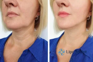 Double chin before and after Hi-Fu treatment 4 Book your double chin treatment Carlton today! We are here to help!
