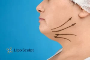 Double chin before and after Hi-Fu treatment 3 Boost your confidence with a Double chin treatment Carlton