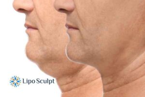 Double chin before and after Hi-Fu treatment 2 Double chin treatment Carlton from Lipo Sculpt - feel more confident today!