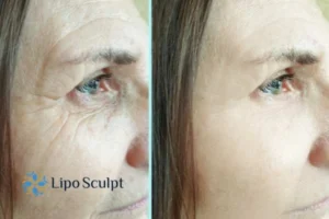 How to Fight Aging Symptoms 2 Do you want to Fight Aging Symptoms Carlton? Contact Lipo Sculpt today!