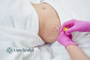 Are The Results From Aqualyx Permanent? 1 Do you want to know how long Aqualyx Carlton results last?
