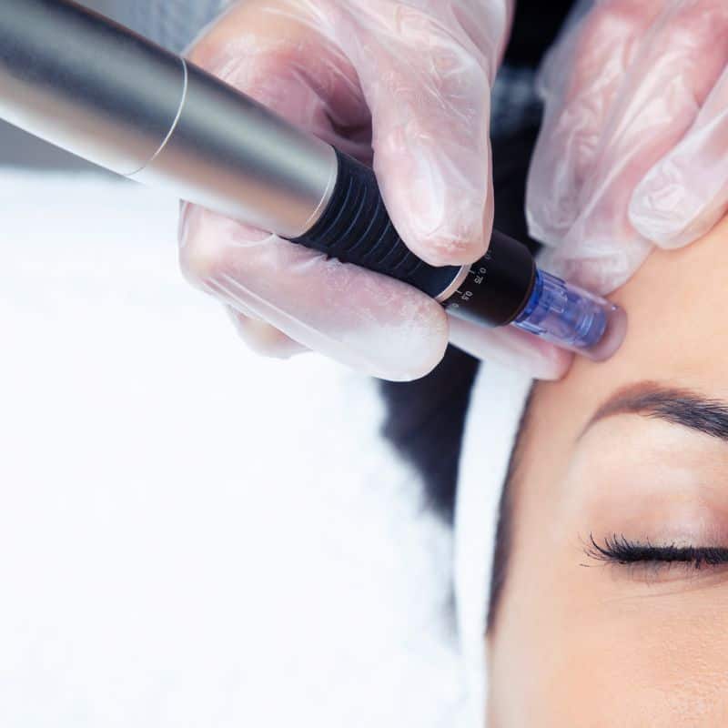 Morpheus8 treatment Carlton from Lipo Sculpt - Book in today!
